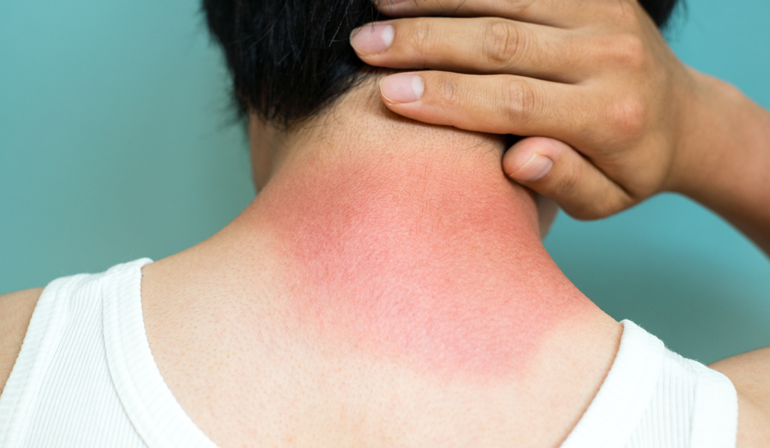 How Severe is Your Burn?